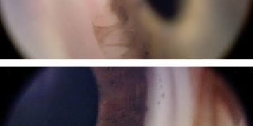 Axenfeld-Rieger syndrome(ARS)