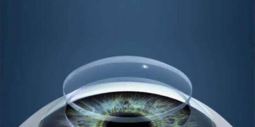 Clinical Notes on Penetrating keratoplasty