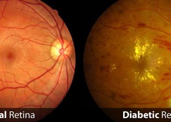 Diabetic eye disease