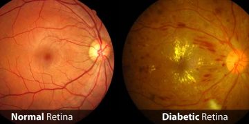 Diabetic eye disease