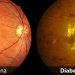 Diabetic eye disease