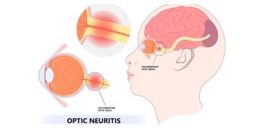 Optic neuritis in brief