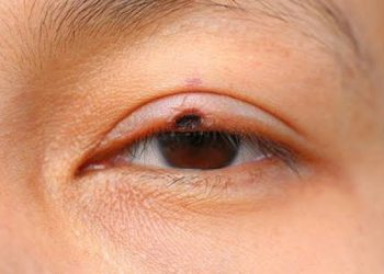 Lid malignancy in brief