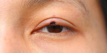 Lid malignancy in brief