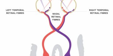 Summary of visual field defects
