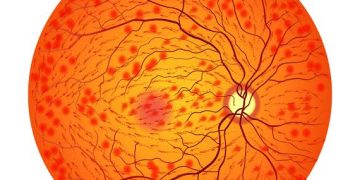 Guidelines for management of CRVO