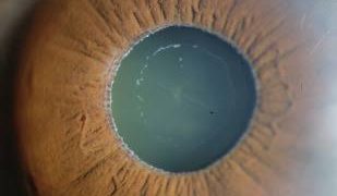 Pseudoexfoliation syndrome facts ( just now in my clinic )