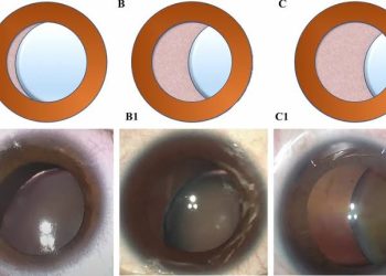 Lens subluxation syndromes