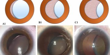 Lens subluxation syndromes