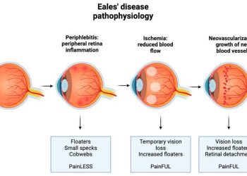 Eales disease