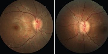 True and pseudo optic disc oedema facts