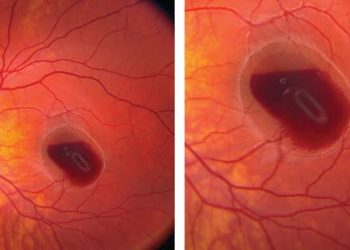 Criteria of Macular Bleeding