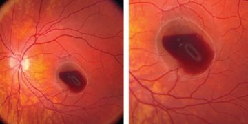 Criteria of Macular Bleeding