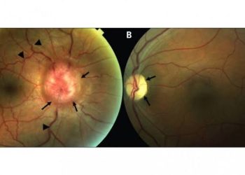 True and Pseudo Foster Kennedy Syndromes