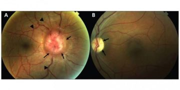 True and Pseudo Foster Kennedy Syndromes