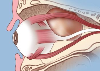 Hints to easily suspect pediatric orbital tumors