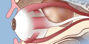 Hints to easily suspect pediatric orbital tumors