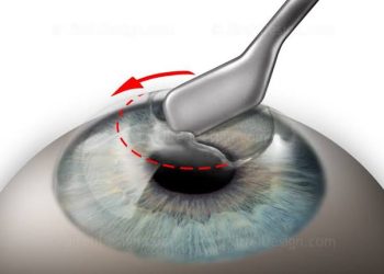Taking a corneal scrape