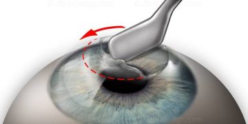 Taking a corneal scrape