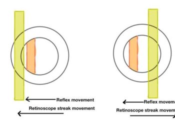 Retinoscopy hints