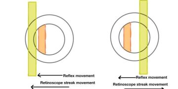 Retinoscopy hints