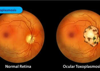 Ocular Toxoplasmosis when and how to treat