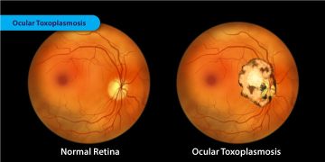 Ocular Toxoplasmosis when and how to treat