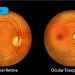 Ocular Toxoplasmosis when and how to treat