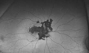 Serpiginous Choroidopathy
