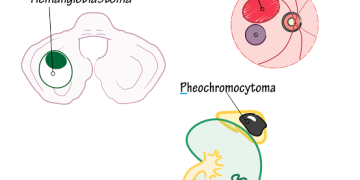 Von Hippel Lindau Syndrome