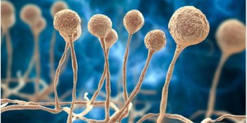 Mucormycosis (phycomycosis)