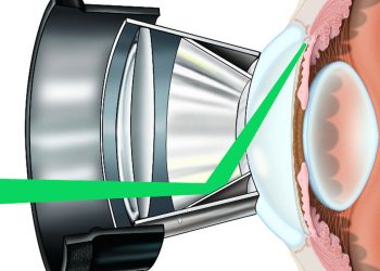 Argon laser trabeculoplasty