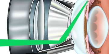 Argon laser trabeculoplasty