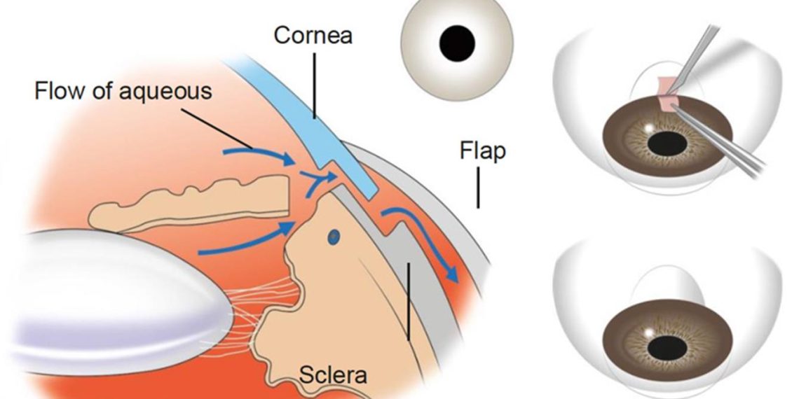 Treatment of bleb-related infection