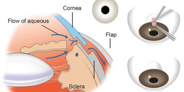 Treatment of bleb-related infection