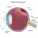 Alarms of Retinal Detachment