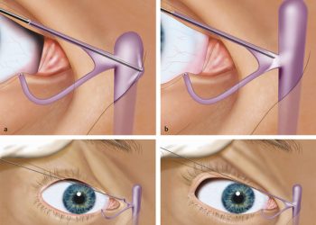 NLD Syringing and probing