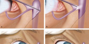 NLD Syringing and probing