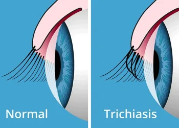 Eyelash disorders capsules