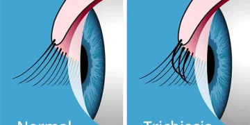 Eyelash disorders capsules