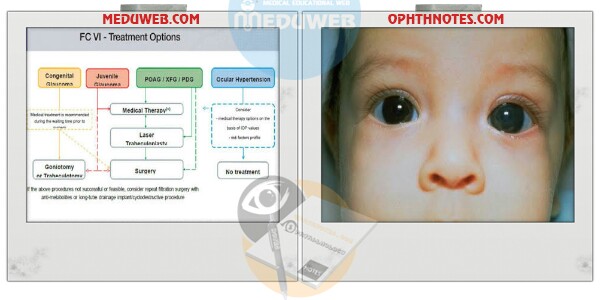 Medical treatment in pediatric glaucomas