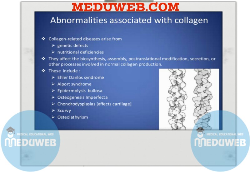 Common Ophthalmic Connective tissue disorder
