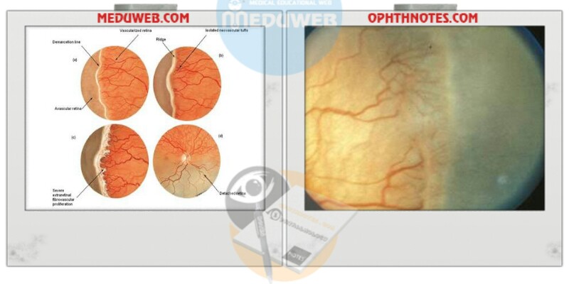 Retinopathy of Prematurity (ROP) screening guidelines 2 Retinopathy of Prematurity (ROP) screening guidelines
