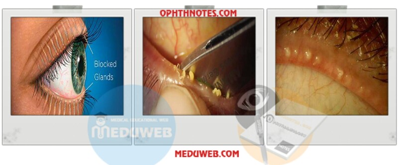 Meibomian gland dysfunction