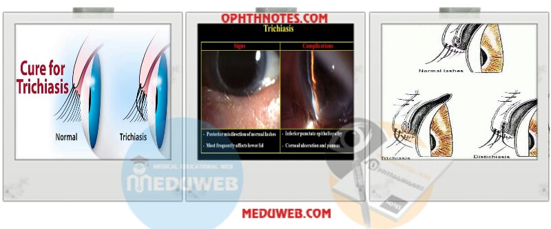 Eyelash disorders capsules