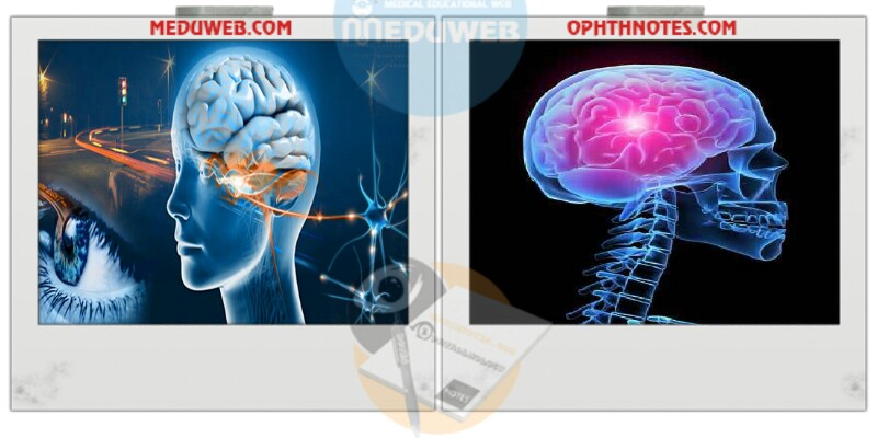 Headache in Ophthalmology common complaint