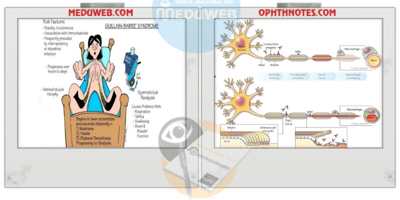 Guillain-Barré Syndrome (GBS)