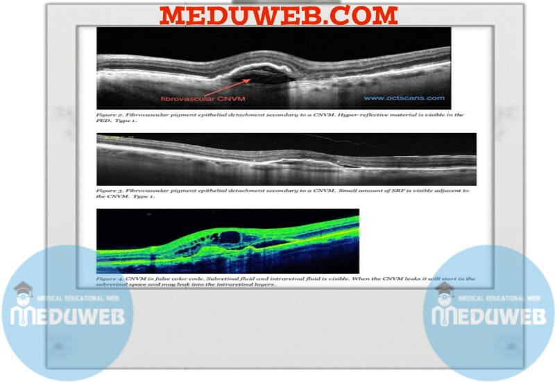 Choroidal Neovascular Membrane