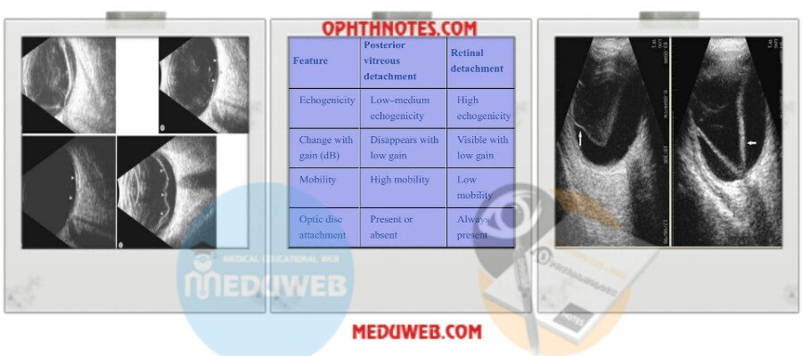How does PVD and RD look in USG and how to differentiate