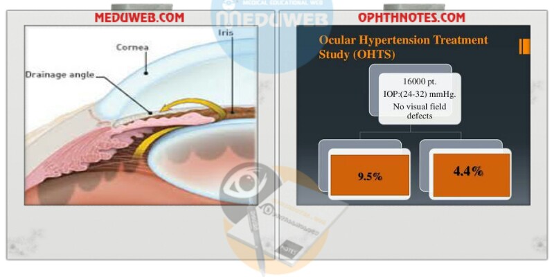 Whether to treat ocular HTN and glaucoma suspect or not to treat ( debatable issue )